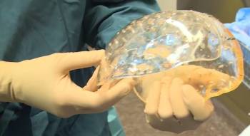 Благодаря технологии 3D-печати женщине пересадили часть черепа