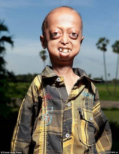 «Прогерия» — редкое заболевание преследующее семью из Индии…