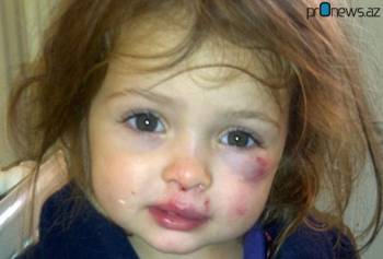 В Шамахе пострадала 3-х летняя девочка оставшись под железными воротами