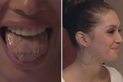 Девушка пришила себе пластик на язык, чтобы похудеть